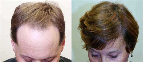 wigs and hair transplant solutions for transgendered men