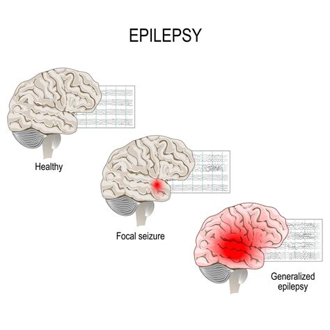 identifying seizuress  prevent injury  speed recovery