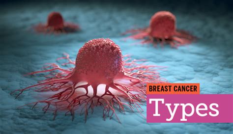 your guide to breast cancer symptoms treatments and more mybcteam