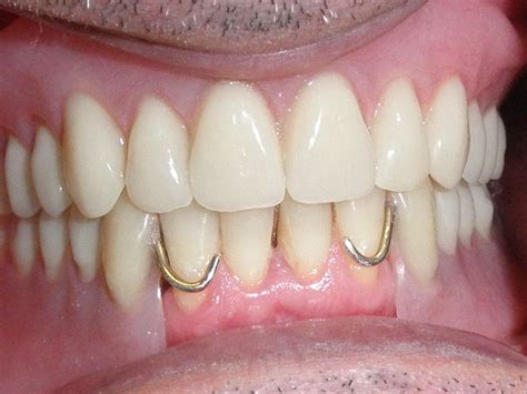 partial dentures bottom front teeth