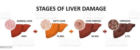 Stages Of Liver Damage Healthy Fatty Liver Fibrosis And Cirrhosis Stock