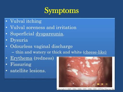 Ppt Candida Infection T Ricpmonas Vaginalis Bacterial Vaginosis