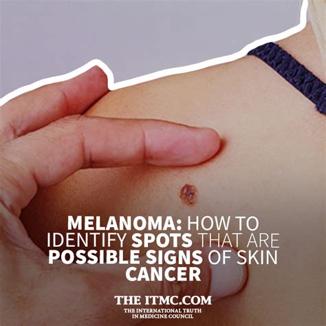 melanoma how to identify spots that are possible signs of