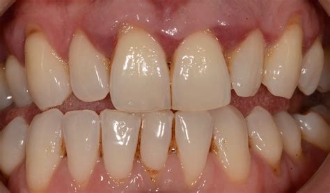 reasons   receding gum  balsall common dental