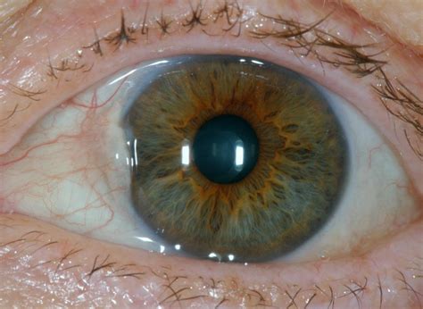 bumps  eyeball  types  treatment
