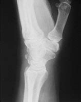 triquetral fracture