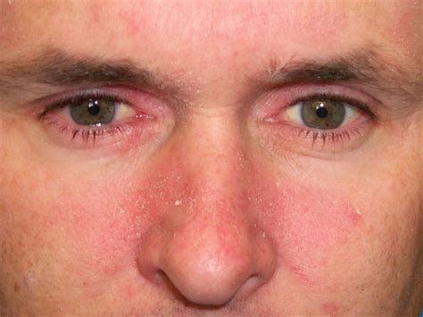 Scarlet Letters Dealing With Vascular Rosacea Face