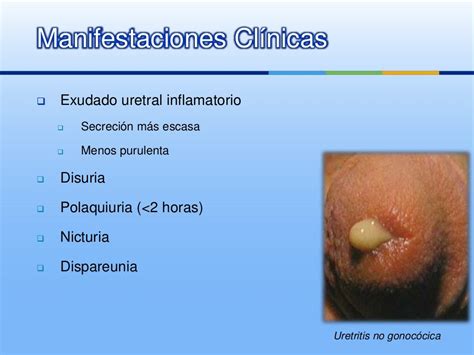 uretritis no gonocócica