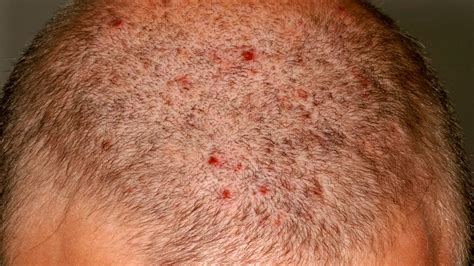 Rash On Back Of Head