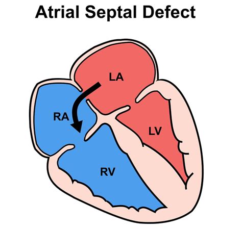 atrial septal defect  symptoms types diagnosis treatment
