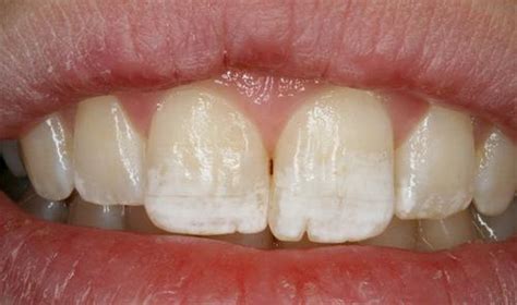 10 conseils pour éliminer la tache blanche sur les dents