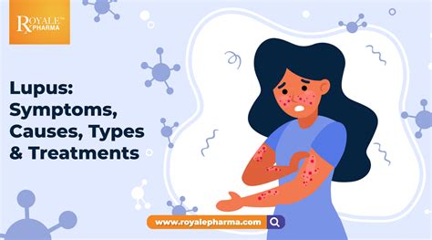 lupus symptoms  types treatments royalepharma