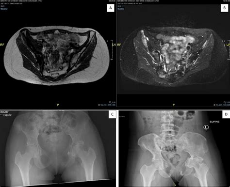 Gorham Stout Disease Interesting Cause Of Pleural Effusion Bmj Case