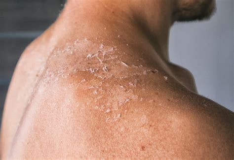 penyakit infeksi jamur kulit gejala faktor risiko pencegahan okezonecom