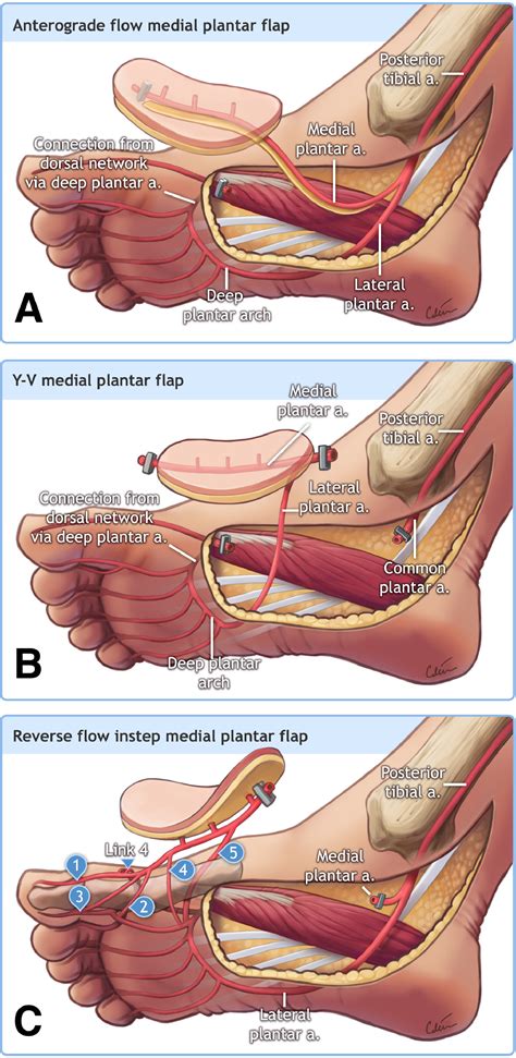 systematic reappraisal   reverse flow medial plantar flap