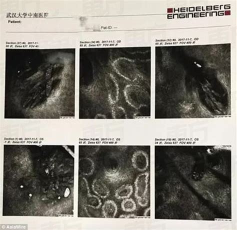 Woman S Itchy Eyes Caused By Mites In Eyelashes In China