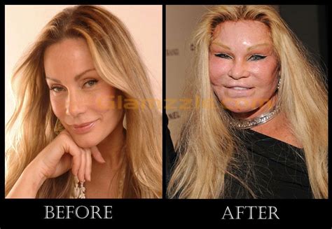 She Used To Be Gorgeous Celebrity Plastic Surgery