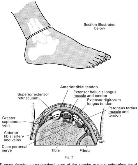 extensor retinaculum syndrome   ankle  injury