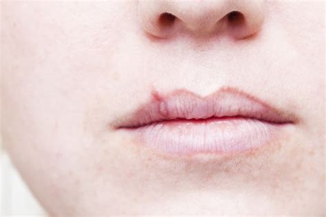 concurrent oral herpes and genital herpes infection