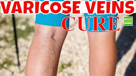 Varicose Veins If You Want To Cure Varicose Veins You Should Follow