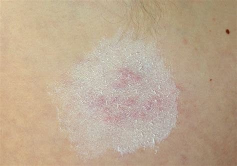 what are the treatments for herpes simplex 1