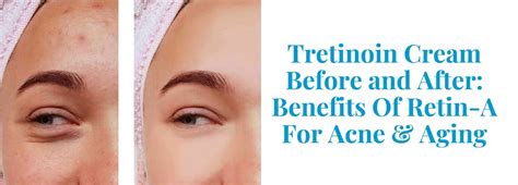 tretinoin before and after benefits of retin a pandia health