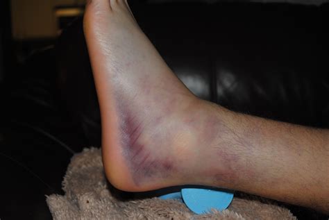 high ankle sprain