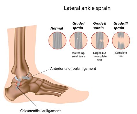 sprained ankle definition anatomy   video town center