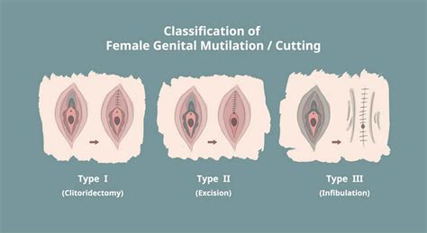 why the law against female genital mutilation should be scrapped