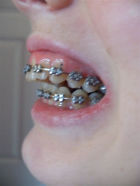My Jaw Surgery Story 6 Months Of Braces And Appointment
