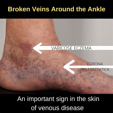 skin  affected  bad leg veins  veincare centre