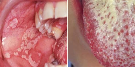 hiv positive mouth sores types of mouth sores and pictures