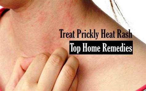 symptoms  treatments  heat rash     home
