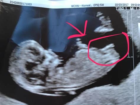 confirmed girl this shot is 12 weeks 2 days in ultrasound gender