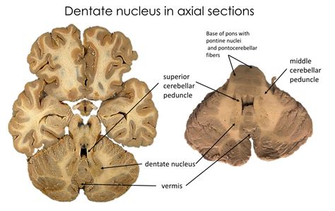 lab week  basal ganglia  cerebellum rehab  lab