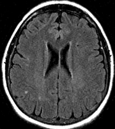 Neuro Lyme Disease Mr Imaging Findings Radiology