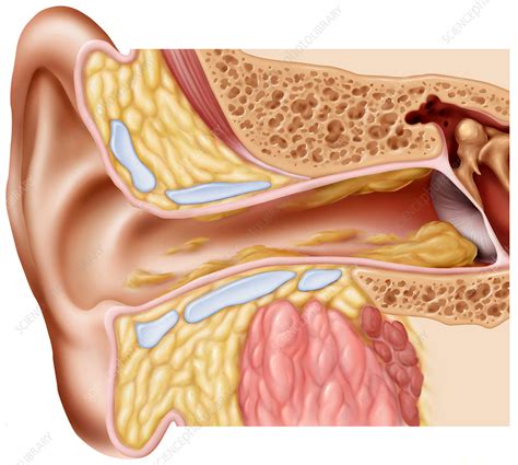 earwax stock image p science photo library