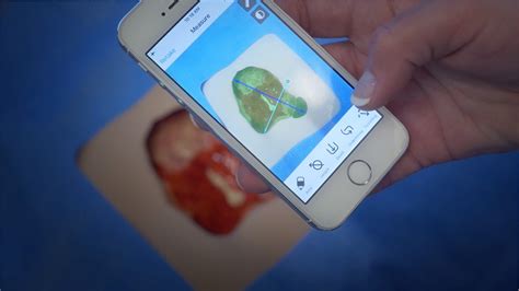 Pointclickcare Launches Skin And Wound Smartphone App Ictandhealth