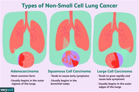 Early Stage Lung Cancer Overview And More