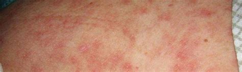 skin rash and sexually transmitted diseases
