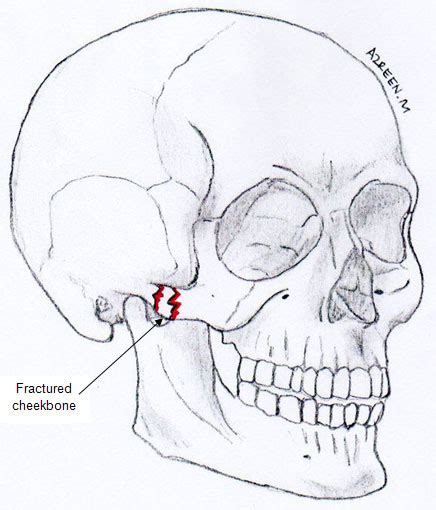 Treatment Of Fractured Cheekbone Portal Myhealth
