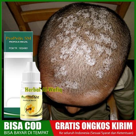 Jual Obat Jamur Kulit Kepala Tinea Kapitis Kurap Di Kepala Shopee