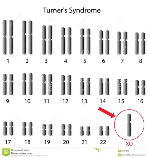 turner syndrom vektor abbildung bild von chromosomen 26951649