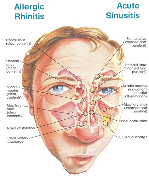 chronic sinusitis medication how treat nasal post drip rhinitis