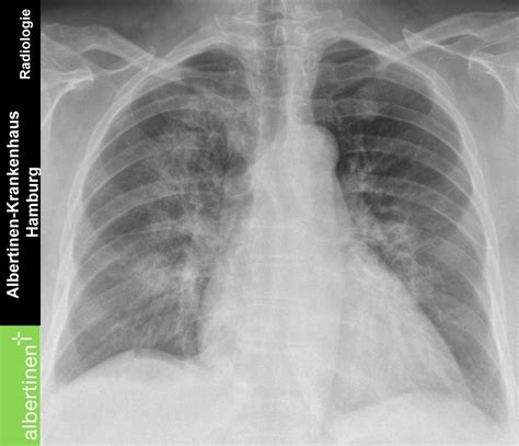 roe thorax bronchopneumonie bds pa doccheck