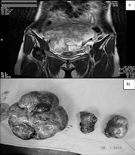a preoperative mri showing bulky pelvic mass b removed uterus with