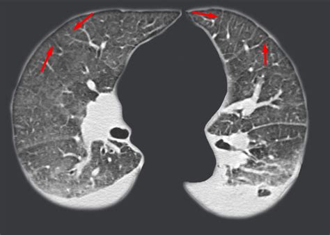 chest radiology