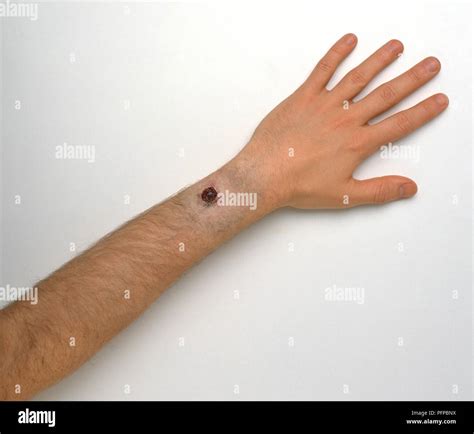 gunshot wound  wrist stock photo alamy