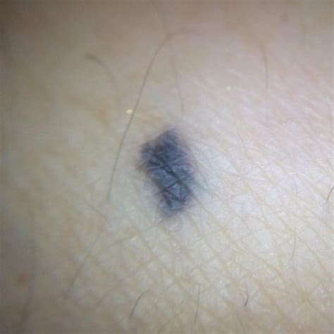 does a blue mole mean possible melanoma — scary symptoms