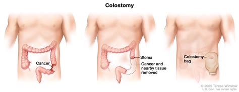Colerectal Cancer Causes Symptoms And Treatments Global